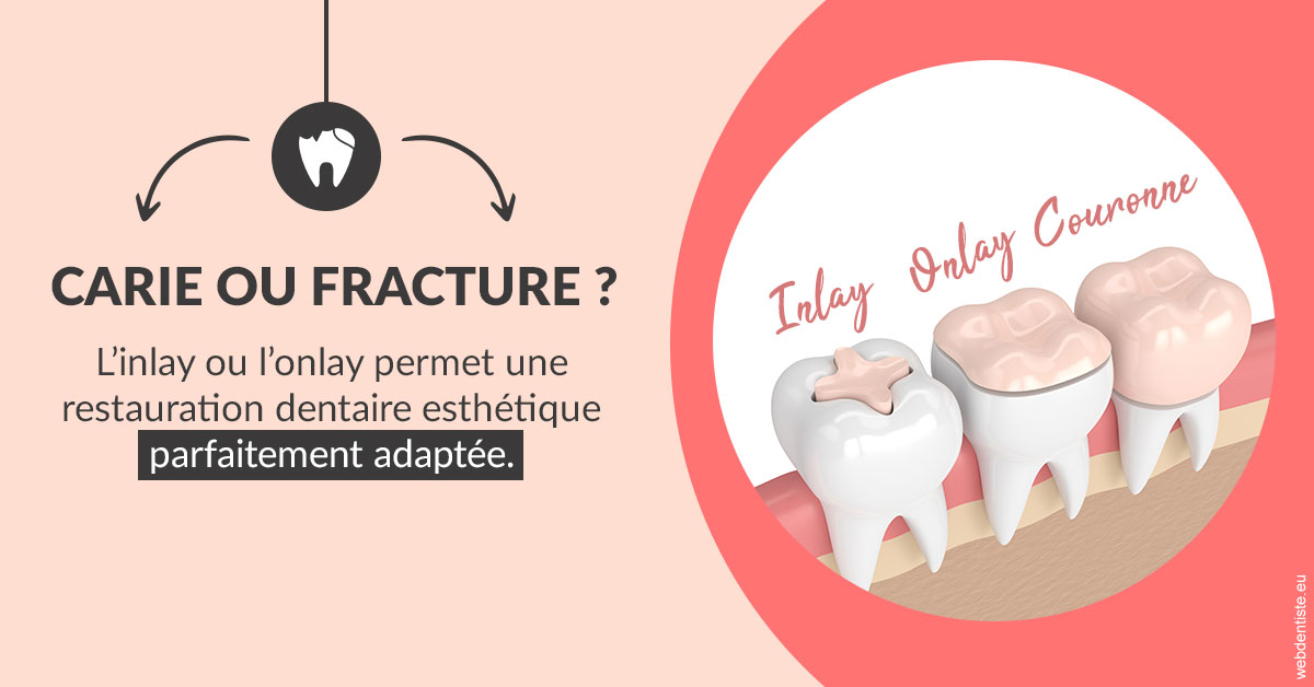 https://dr-bartmann-priscilla.chirurgiens-dentistes.fr/T2 2023 - Carie ou fracture 2