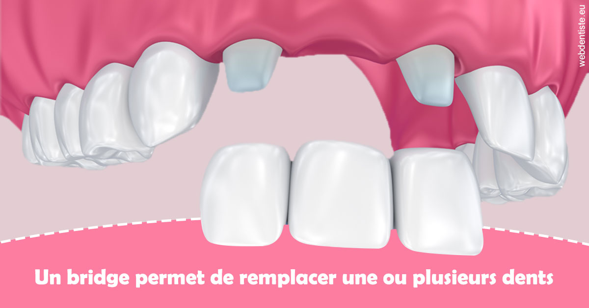 https://dr-bartmann-priscilla.chirurgiens-dentistes.fr/Bridge remplacer dents 2