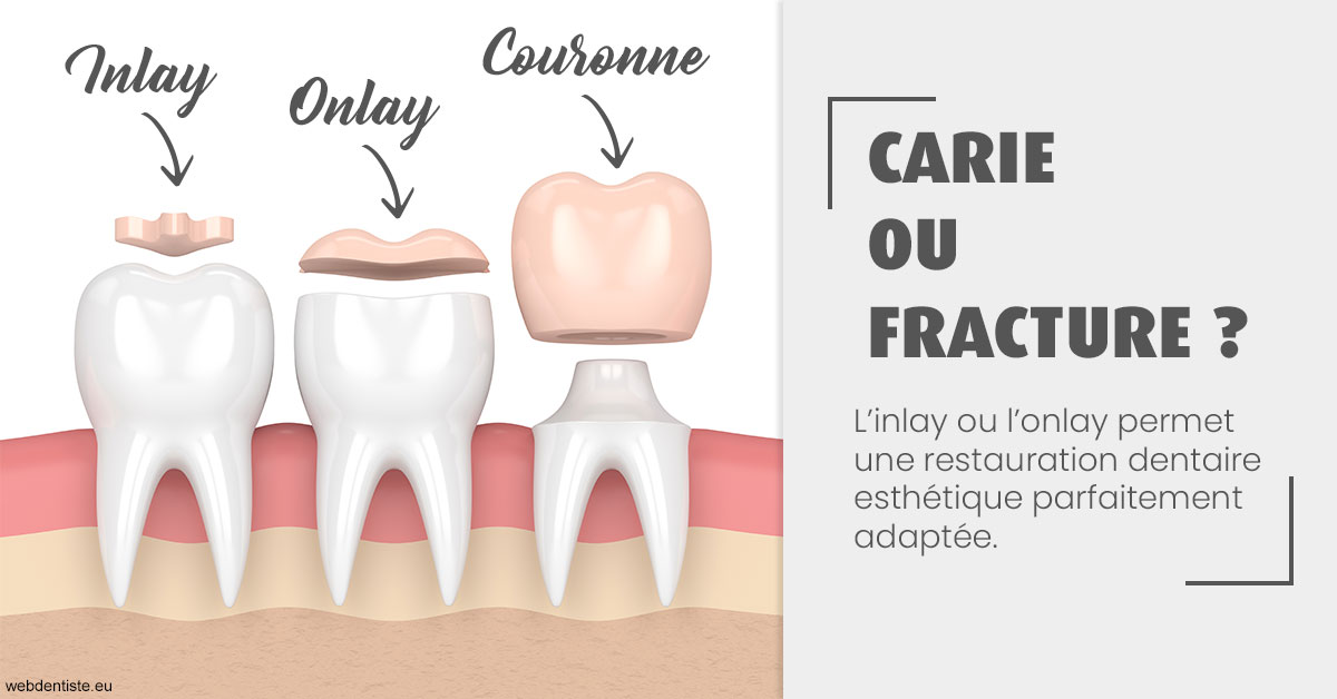 https://dr-bartmann-priscilla.chirurgiens-dentistes.fr/T2 2023 - Carie ou fracture 1