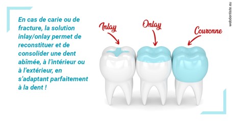 https://dr-bartmann-priscilla.chirurgiens-dentistes.fr/L'INLAY ou l'ONLAY