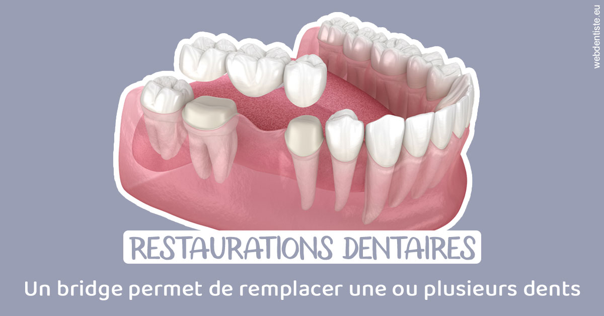 https://dr-bartmann-priscilla.chirurgiens-dentistes.fr/Bridge remplacer dents 1