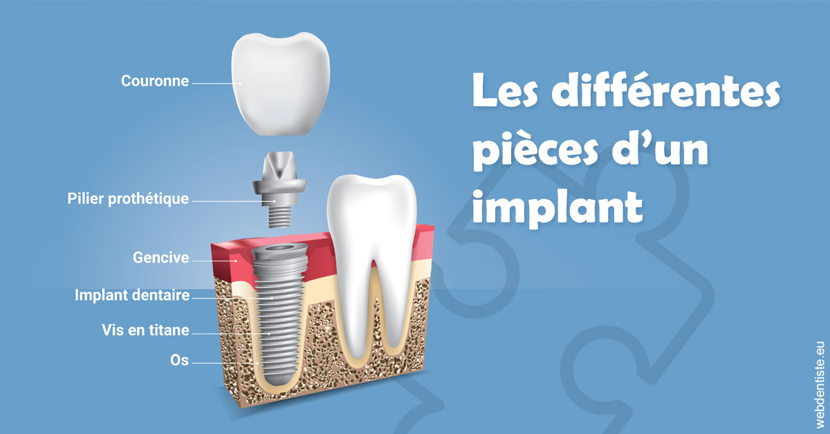 https://dr-bartmann-priscilla.chirurgiens-dentistes.fr/Les différentes pièces d’un implant 1